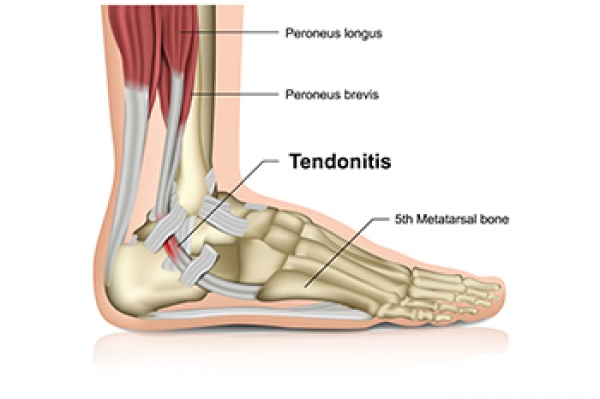 Sudden pain store in achilles tendon